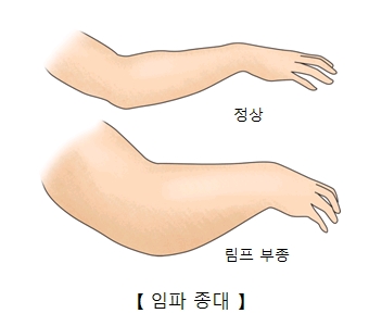 임파종대