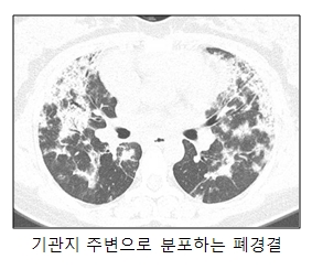 원인불명 신종 폐질환