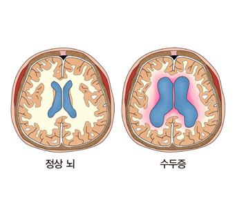 수두증