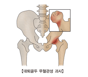대퇴골두 무혈성 괴사