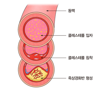HDL.